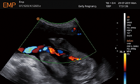 Fetal Umbilical Artery